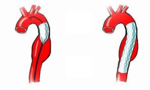 Методы эндоваскулярной хирургии аневризмы артерий головного мозга