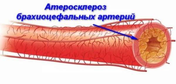 Лечение нестенозирующего атеросклероза внечерепных брахиоцефальных артерий, стадии, отличия видов, в чем опасность