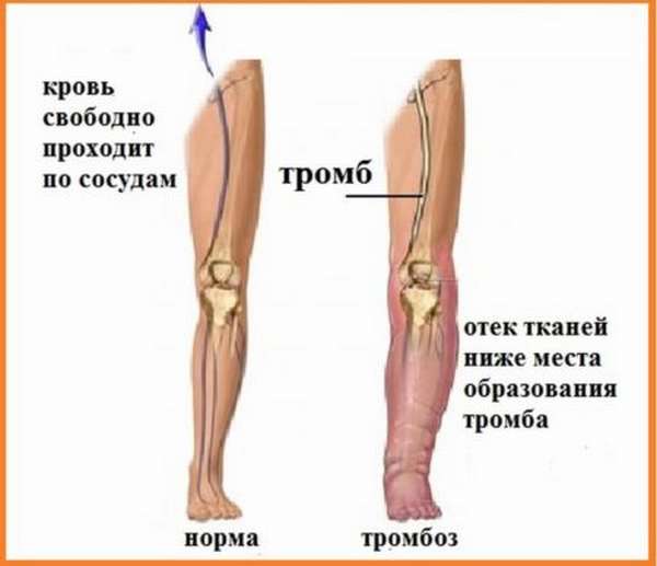 Диагностика и симптомы, указывающие на появление тромба в ноге, причины возникновения, методы профилактики и лечения
