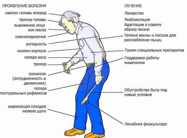 Симптомы болезни Паркинсона