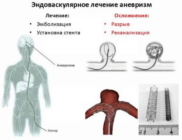 Методы эндоваскулярной хирургии аневризмы артерий головного мозга