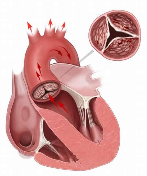 Возможно ли эффективное лечение народными средствами атеросклероза аорты сердца