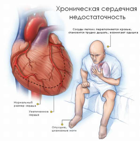 Особенности диагностики и симптомы кашля при сердечной недостаточности