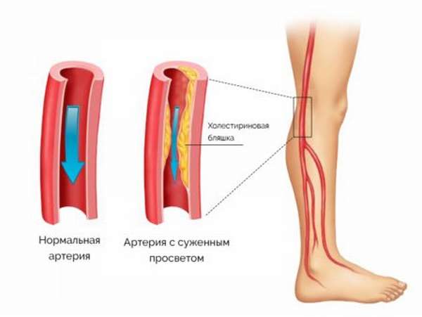 Причины развития, возможные последствия и лечение стенозирующего атеросклероза артерий нижних конечностей