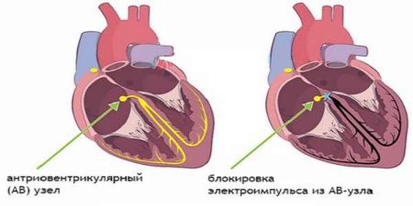 В чем опасность для жизни атриовентрикулярной блокады узла сердца?