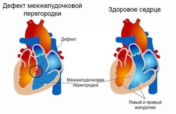 Причины шумов в сердце у ребенка, характеристики определяющих патологий, способы диагностики и вероятность исцеления