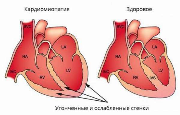 Симптомы кардиопатии, типы патологии и характеристики, методы диагностики и лечения