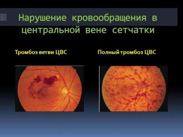Возникновение тромбоза ЦВС глаза – диагностирование патологии, лечение, осложняющие факторы