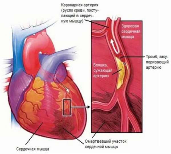 Какие бывают виды маркеров инфаркта миокарда, и что означает каждый из них?
