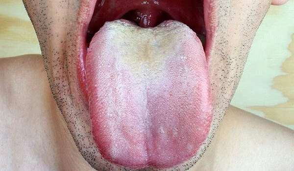Симптомы кандидоза полости рта у взрослых