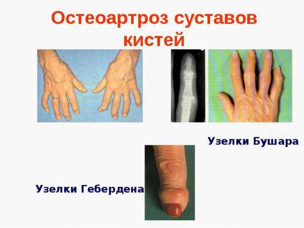 Классификация остеоартроза кистей рук