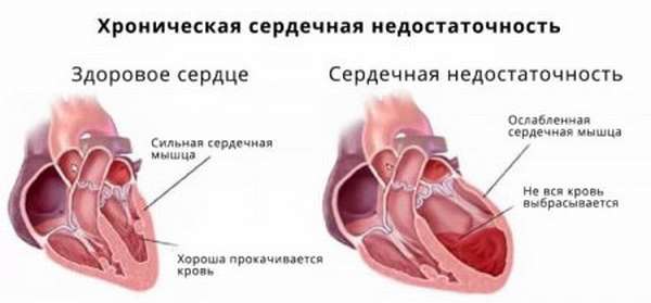 Классификация сердечной недостаточности и особенности лечения патологии
