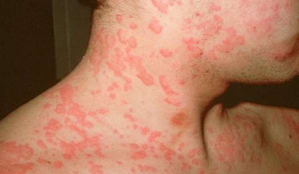 Аллергия на коже у взрослых, симптомы, диагностика, лечение