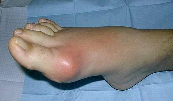 Что такое подагра у мужчин на ногах? Фото и как ее лечить