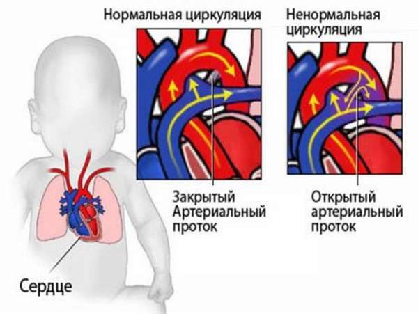 Особенности проявлений порока сердца и его влияние на качество жизни человека