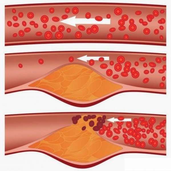 Причины появления тромбоза артерий нижних конечностей, почему происходит тромбирование вен