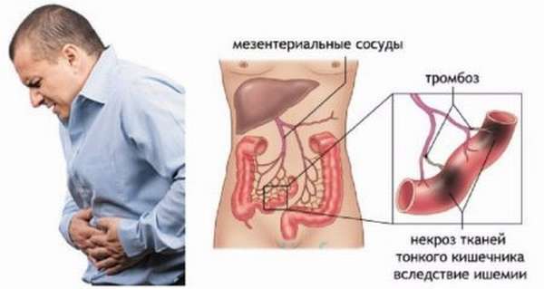 Все о тромбозе сосудов кишечника и причинах его возникновения, проявления и методы лечения