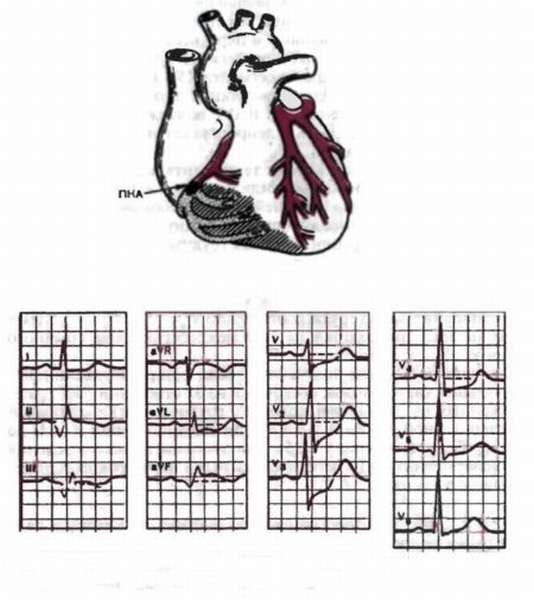 Особенности инфаркта задней стенки сердца и его отличия от других типов патологии