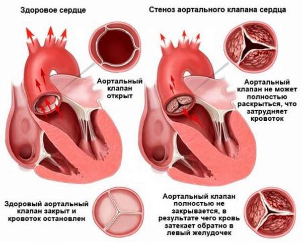 Особенности развития трикуспидальной недостаточности сердца и тактика лечения