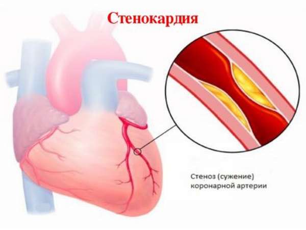 Факторы возникновения резкой боли в сердце и ее устранение