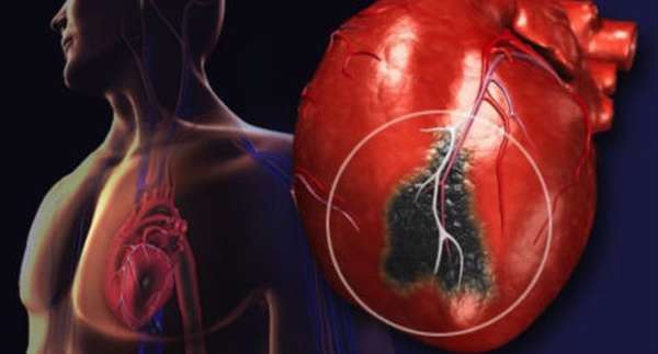 Тактика лечения после перенесенного инфаркта миокарда, режим питания