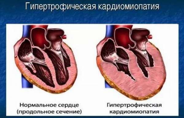 Симптомы кардиопатии, типы патологии и характеристики, методы диагностики и лечения