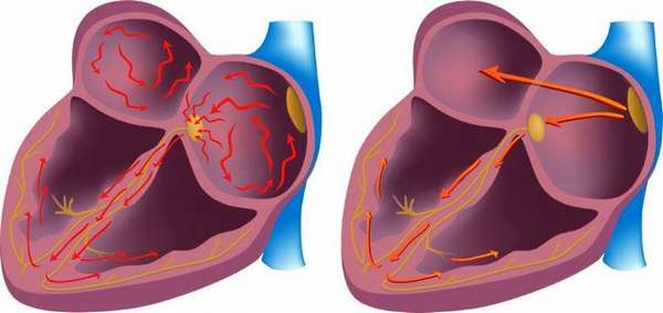 Как лечить мерцательную аритмию сердца, современные препараты для лечения