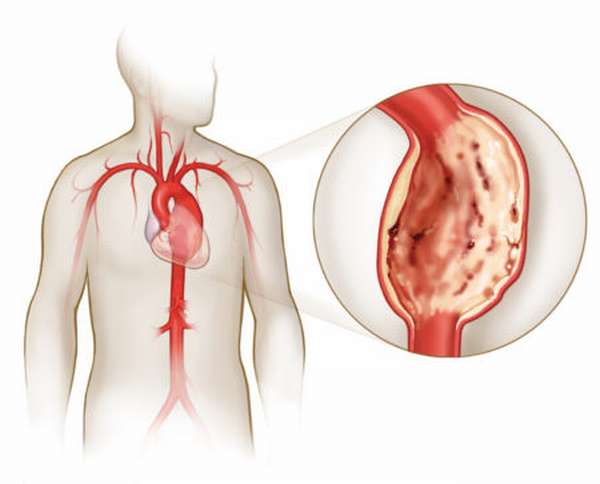 Причины развития аневризмы на стенках сосудов сердца, профилактика патологии