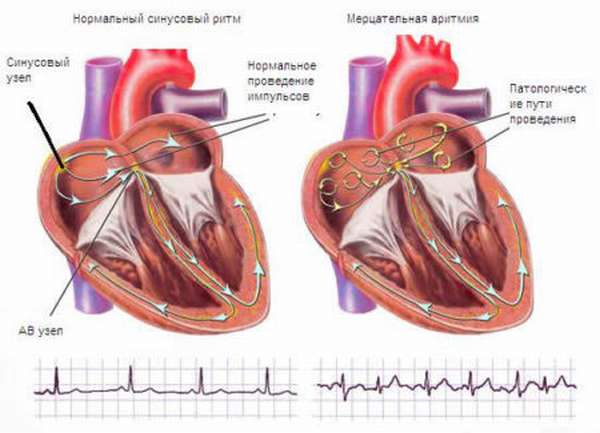 Как объяснить появление перебоев в сердце при остеохондрозе, особенности патологии и методы лечения