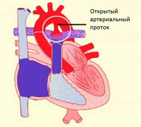 Причины формирвоания открытого артериального протока, методы диагностики и лечения