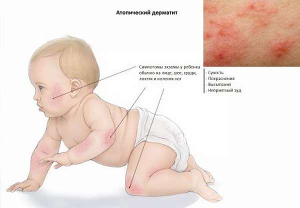Причины повышения эозинофилов у ребенка: какие заболевания могут вызвать отклонение от нормы?