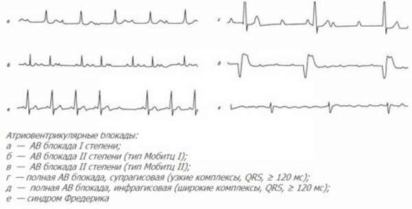 Как расшифровать на ЭКГ признаки нарушения ритма сердцебиения