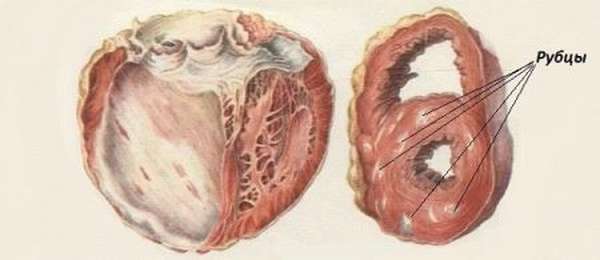 Какие симптомы и последствия рубца на сердце, появившегося после инфаркта