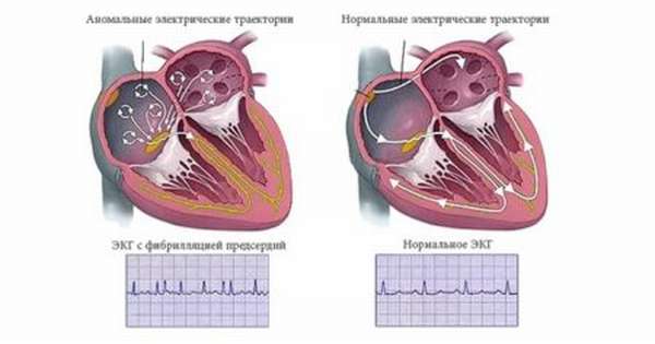 В чем опасность аритмии сердца, формы патологии, диагностика, как распознать и лечить патологию
