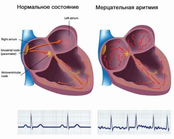 Лечение мерцательной аритмии сердца народными средствами, причины заболевания и профилактика