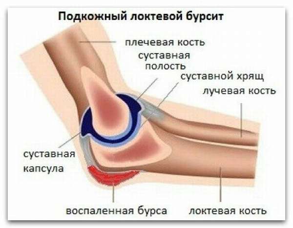 Причины бурсита локтевого сустава