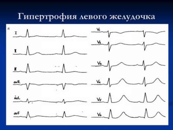 Отображение гипертрофии левого желудочка сердца на результатах ЭКГ