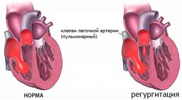 Особенности заболеваний клапана сердца, симптомы, диагностика и методы лечения