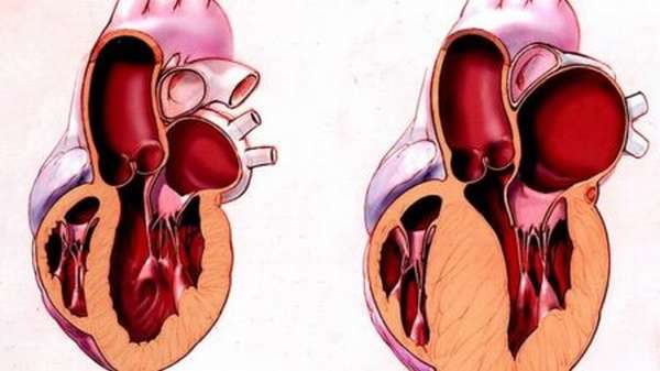 Причины гипертрофии и дистрофии левого желудочка сердца, способы лечения