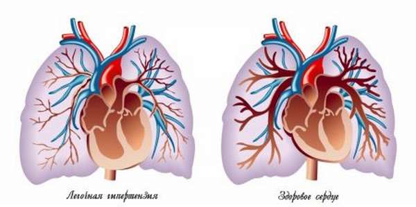 Что является причиной сердечно-легочной недостаточности сердце или легкие?