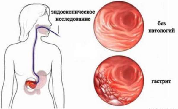 Что вызывает чувство жжения в грудной клетке? Как избавиться от этого симптома?