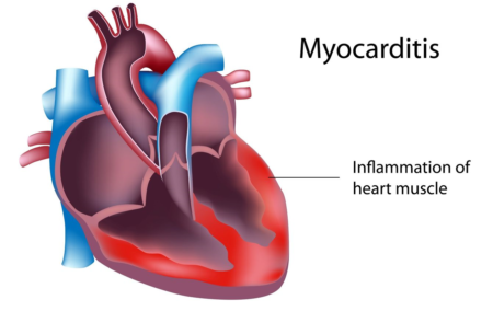 Что необходимо знать о воспалительных заболеваниях сердца каждому человеку?