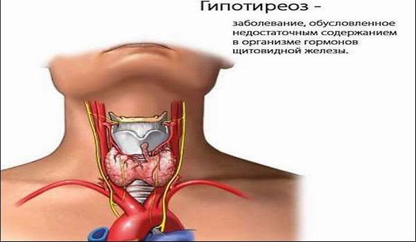 Гипотиреоз щитовидной железы - симптомы и лечение