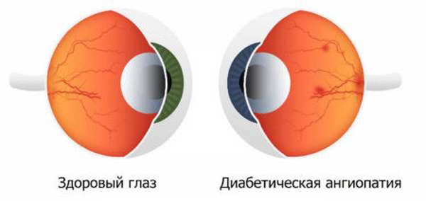 Причины возникновения ангиопатии сетчатки глазных сосудов