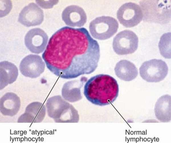 О чем говорит наличие атипичных лимфоцитов в крови, и стоит ли волноваться?