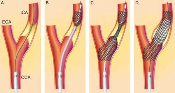 Степени проявления стенозирующего атеросклероза брахиоцефальных артерий