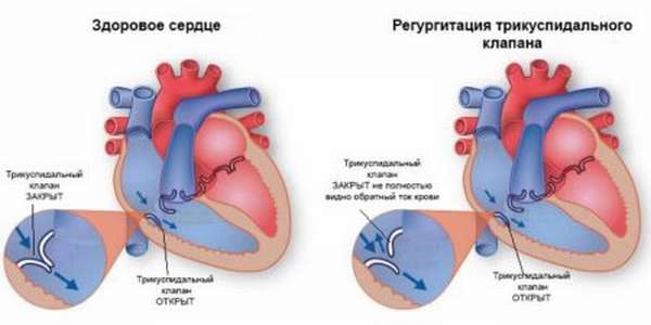 Особенности и оценка опасности для здоровья при регургитации на клапане легочной артерии 1 степени
