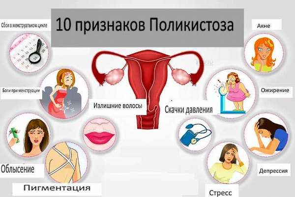 Какие симптомы и как лечить поликистоз яичников у женщин
