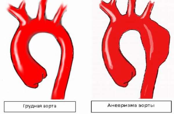 Развитие аневризмы сердца после инфаркта, прогнозы и рекомендации врачей