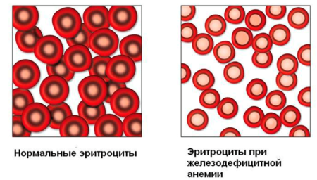 Что необходимо знать о пониженном гемоглобине каждому человеку?